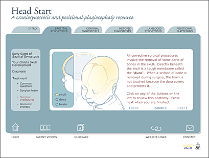 Page from the Sagittal Synostosis section of the Heart Start web site