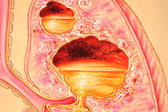 image of Lung Abscess illustration