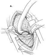 Implantation of the Jarvik 2000 Ventricular Assist Device