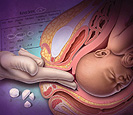 Cervical Ripening and Labor Induction