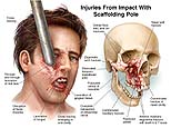 Injuries from Impact with Scaffolding