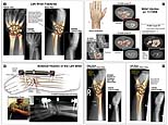 Wrist Injuries, Fixation and Repair