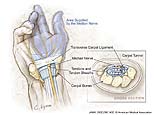 Carpal Tunnel Syndrome