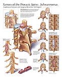 Tumors of the Thoracic Spine