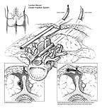 Implantation of the Jarvik 2000 Ventricular Assist Device