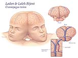 Craniopagous Twins